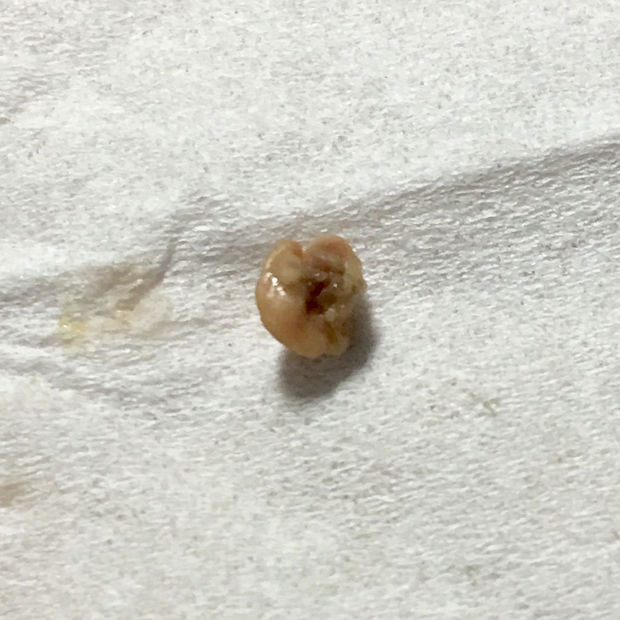 早上咳出来黄色固态小块状物每天早上起来感觉喉咙卡了东西 用力呕一