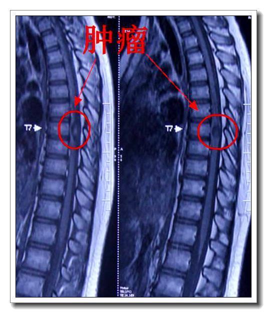 病例:胸7椎管内表皮样囊肿一例