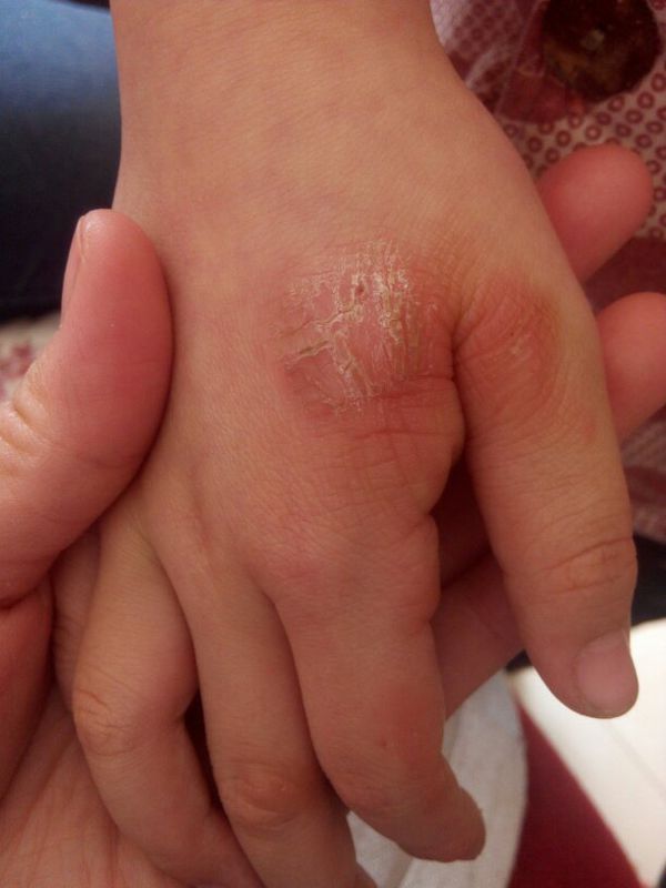 和手指上起树皮一样的硬皮,从4岁开始起到六岁,抹普通治疗皮肤的药膏