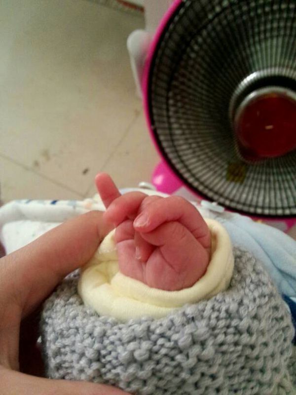 求助,宝宝35天宝宝手长歪了,而且整五个手指都是往小指方向的感觉大