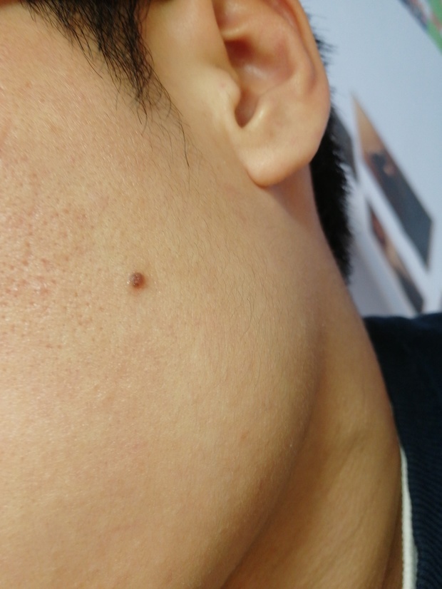 28 这个不是痘,是皮肤肌底瘤,是人群里面很常见 追问: 跟皮肤纤维瘤一
