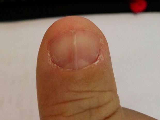指甲有竖纹并断裂是什么原因?