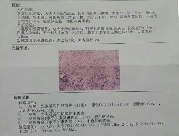 乳腺癌病理诊断报告