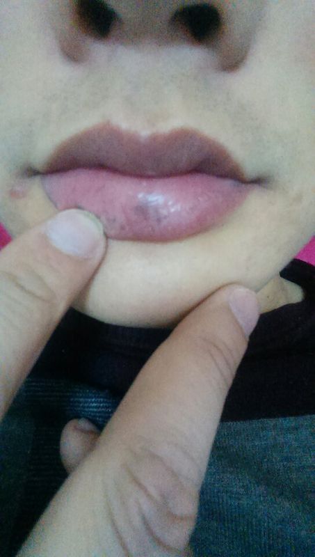 我下嘴唇长了几块小的黑点,请问这是什么原因?可以去掉吗?
