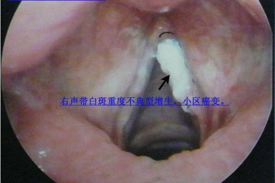警惕声带白斑癌变