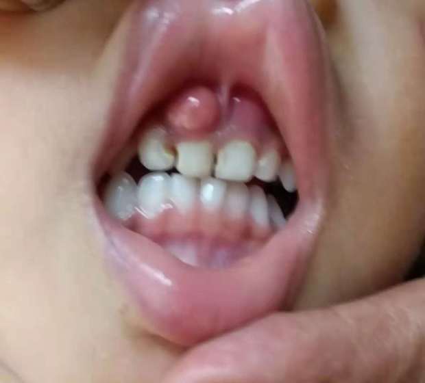四岁孩子上牙龈长肉包几天了,是什么原因?什么病?怎么