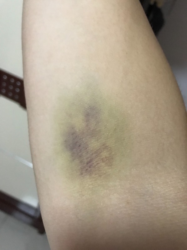 胳膊打了针抽血,第二天就泡了温泉!