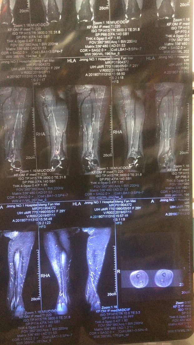 大腿ct片如果有问题怎么显示,谁能帮我看看有什么问题