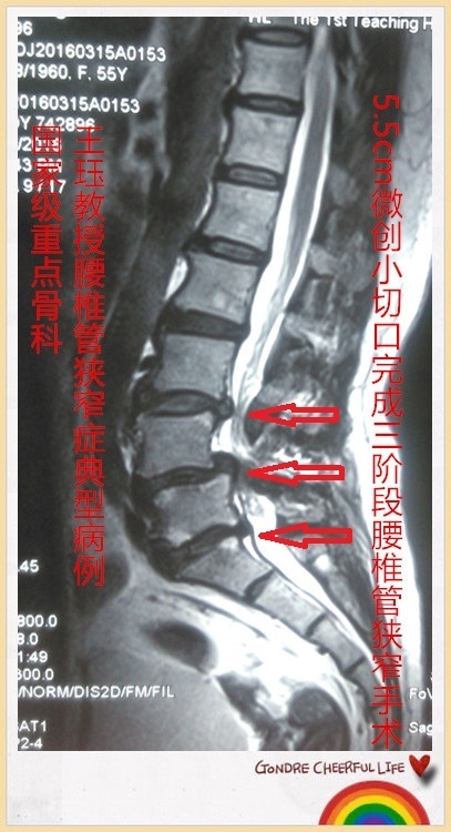 病例183:5.5cm微创小切口完成三阶段腰椎管狭窄手术