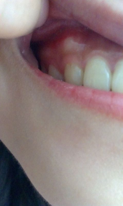 今天突然发现牙龈上长了个包,不去弄它不痛,用舌头去碰它就有点碰口腔