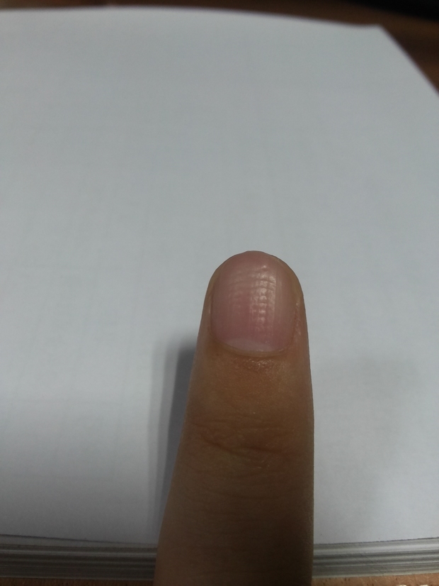我的指甲坑坑洼洼的怎么回事?