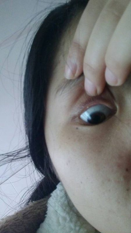 睫毛眼皮底下长了一粒白色的东西,是什么?以前从来没有过
