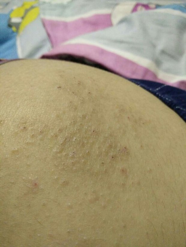 请问这种是什么皮肤病,每年的10月份就开始在大腿臀部