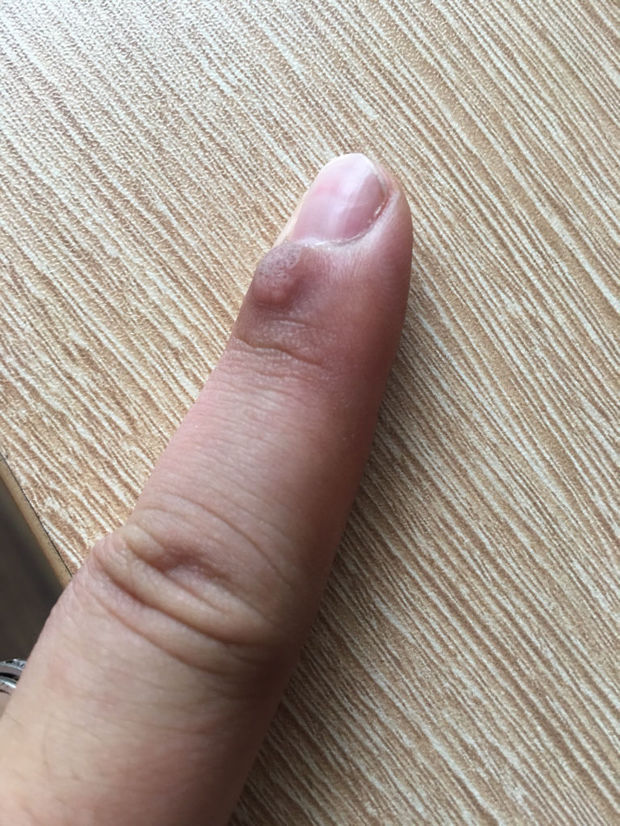手指上长了个像鸡眼的东西,贴鸡眼膏不仅没好,反而长更大了,不知道是