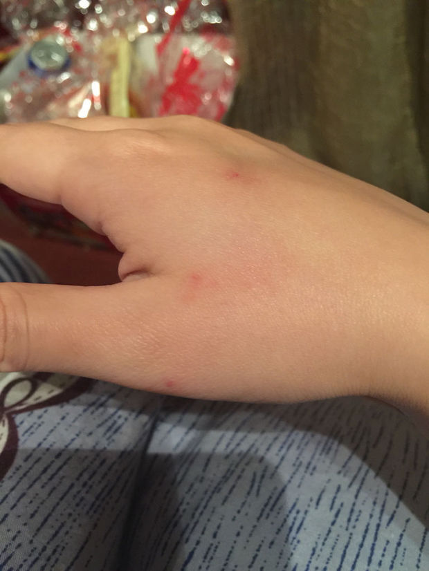 手上有三四个这样的小红点点 不痛不痒 在皮肤里层 按压有点褪色 好像