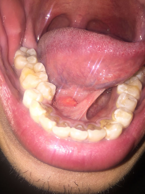 口腔里,舌头下面,但不是舌头上长了个肉芽.