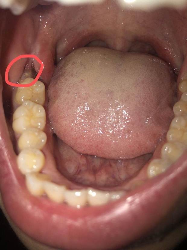 拔完智齿第三天牙床上这个白色东西是什么