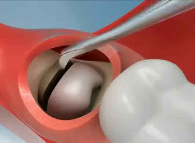动画视频演示微创拔牙过程,阻生智齿切割拔除!