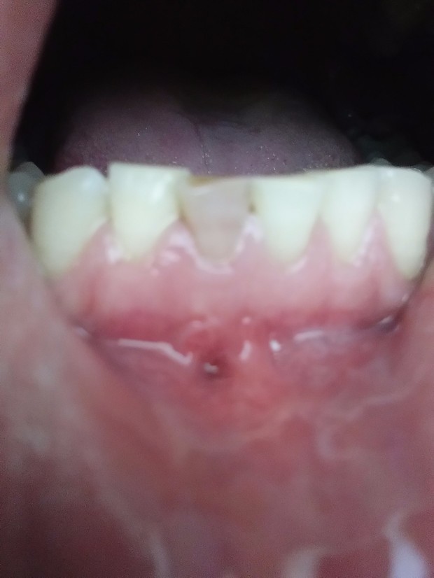 牙龈瘘管 牙齿变黑了 复发 可以不做根管治疗吗?