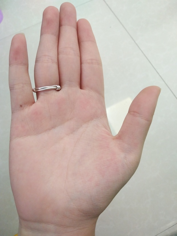 已解决:手心后天长痣这算合痣吗?