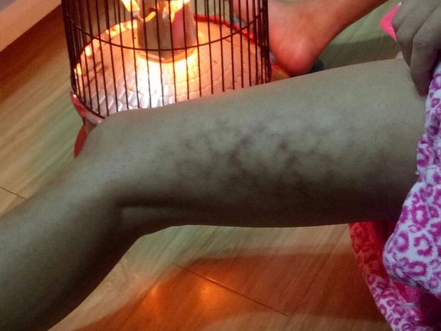 怀孕后大腿上长紫色的纹路