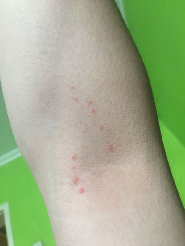 请问右臂内侧突然特别痒,挠完会起包,过数分钟后包就变成照片这样的红