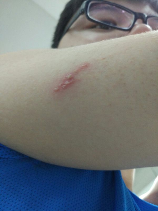 胳膊上疑似被虫子咬起类似水泡的红疹