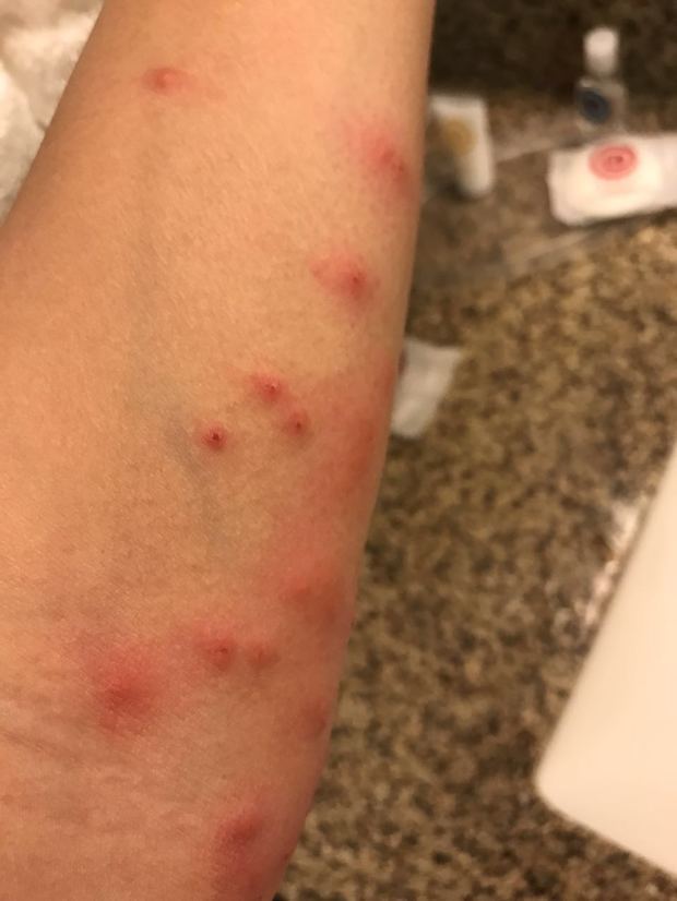 请问这是过敏还是被跳蚤咬了?该如何治疗?