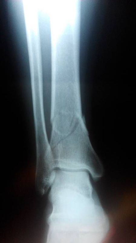 小腿骨折需要做手术吗?有x光片,因为在国外,不方便,请