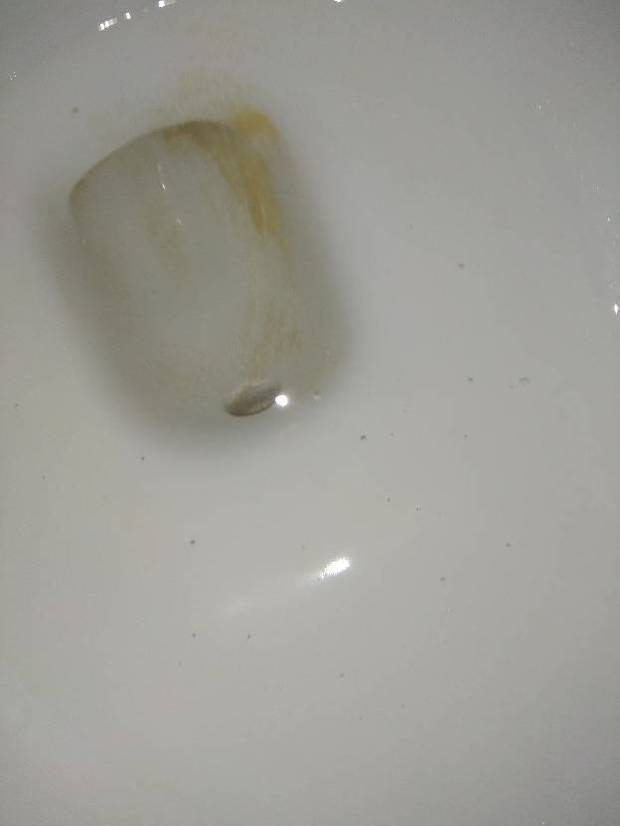 尿里有很小很分散的泡沫是怎么回事?