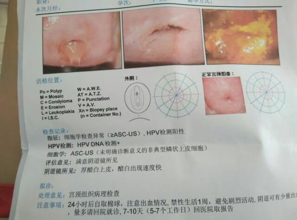 这几张检查单分别是我的tct,hpv,阴道镜,活检结果有过这方面看病经历