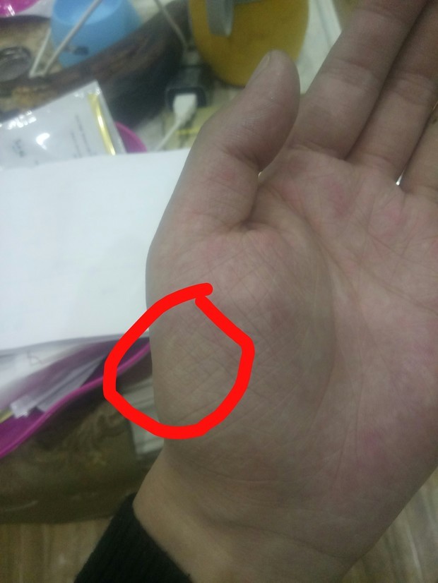 发现大鱼际一处疑似萎缩,麻烦看一下是不是!