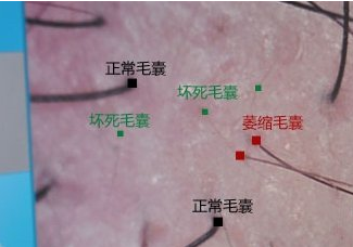 头发毛囊坏死的图,头发毛囊坏死怎么看