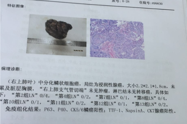 肺结节投保险理赔判决 肺结节保险公司会报吗