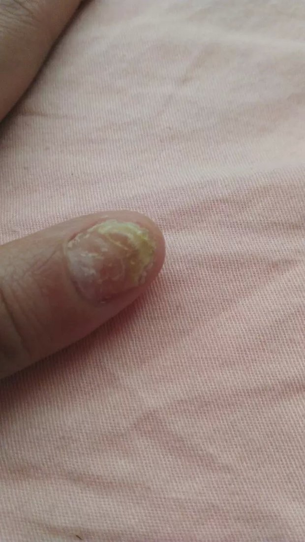 手指真菌感染