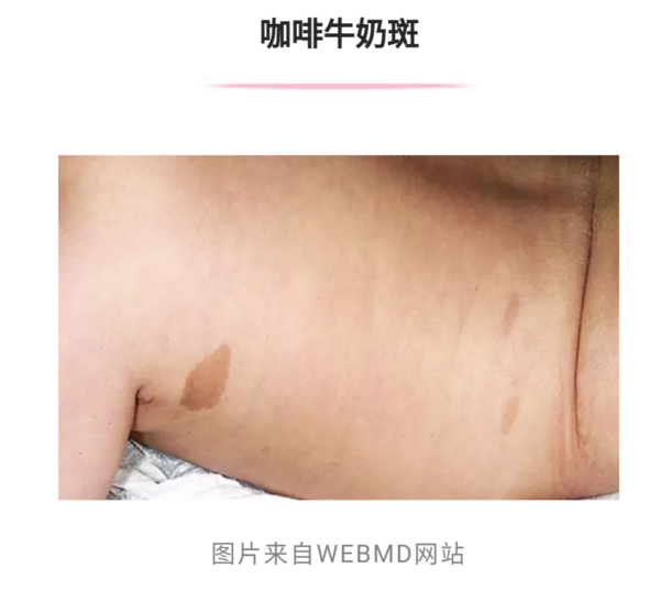 很多宝宝身上都有一两个咖啡牛奶斑,通常无需治疗.