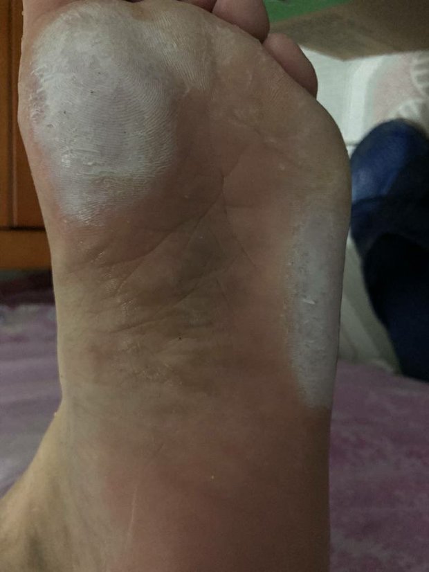 为啥用热水泡完脚,脚底板有白色的这?