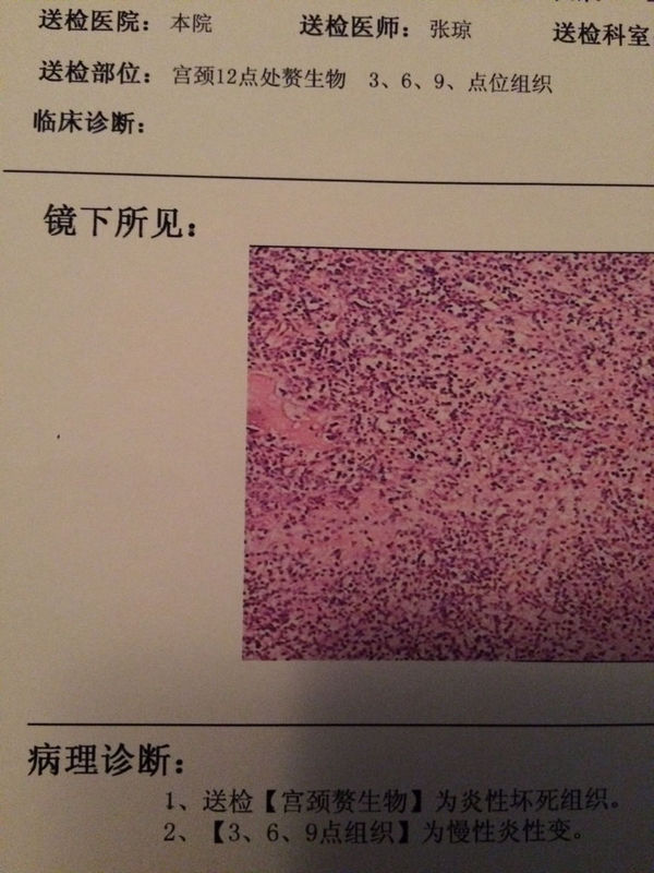 去医院检查.医生说我宫颈长了一个疙瘩