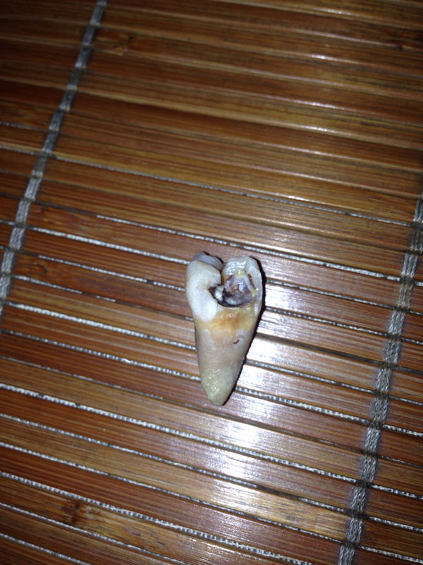 这颗大牙以前蛀牙补过 但是后来补的地方掉了 就一个坑 之后就很松动