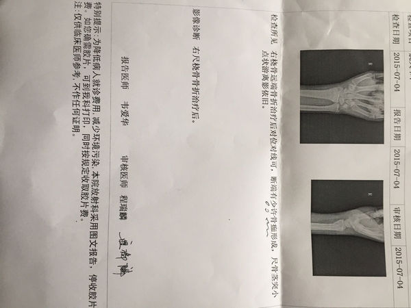 右桡骨远端骨折治疗后对位线可,断端有少许骨痂形成,尺骨茎突小点状