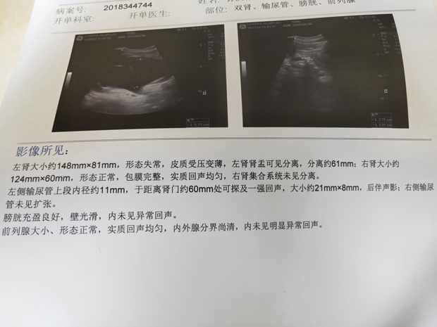 肾结石很严重怎么办?