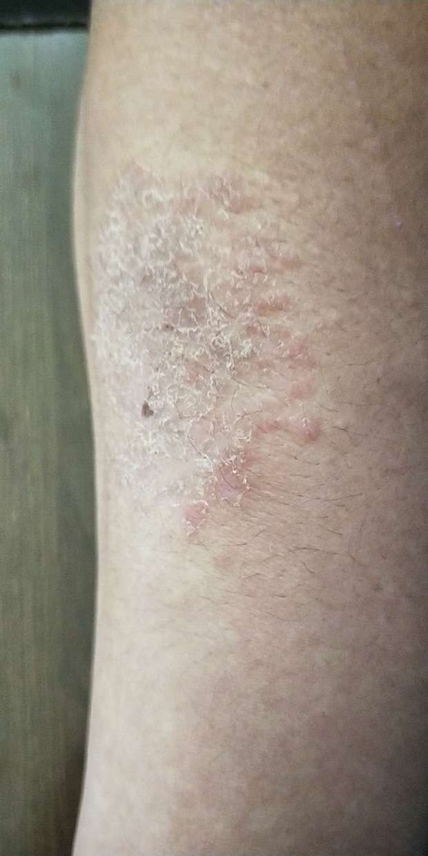 胳膊一年前在刚模板上擦伤一小片,如今表面又厚又干,像鱼鳞一样,而且