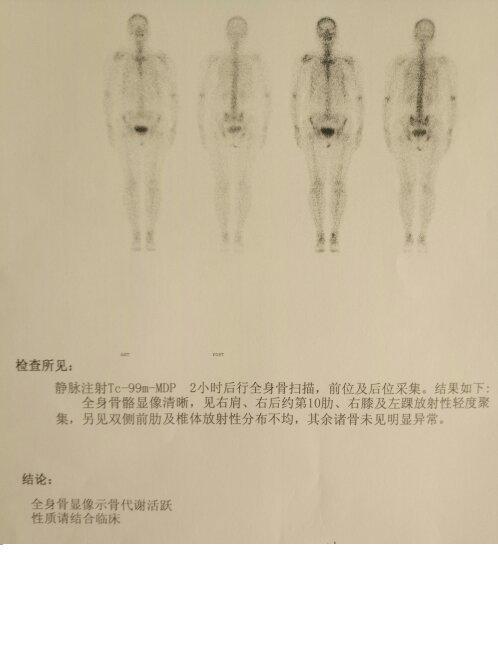 做完骨扫描:放射性轻度聚集是什么意思