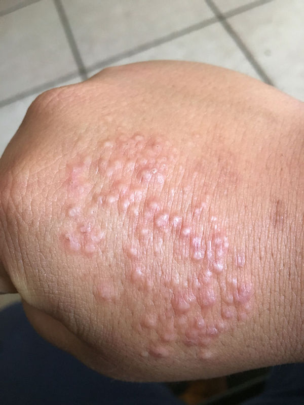 手背起湿疹了,去年开始起一个痘痘,还以为蚊子咬的
