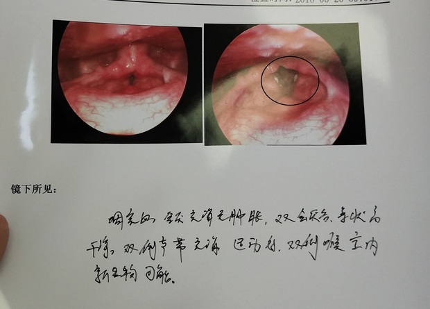 去医院检查今天医生让我做了喉镜,检查出来喉咙里面有白白凸起的东西