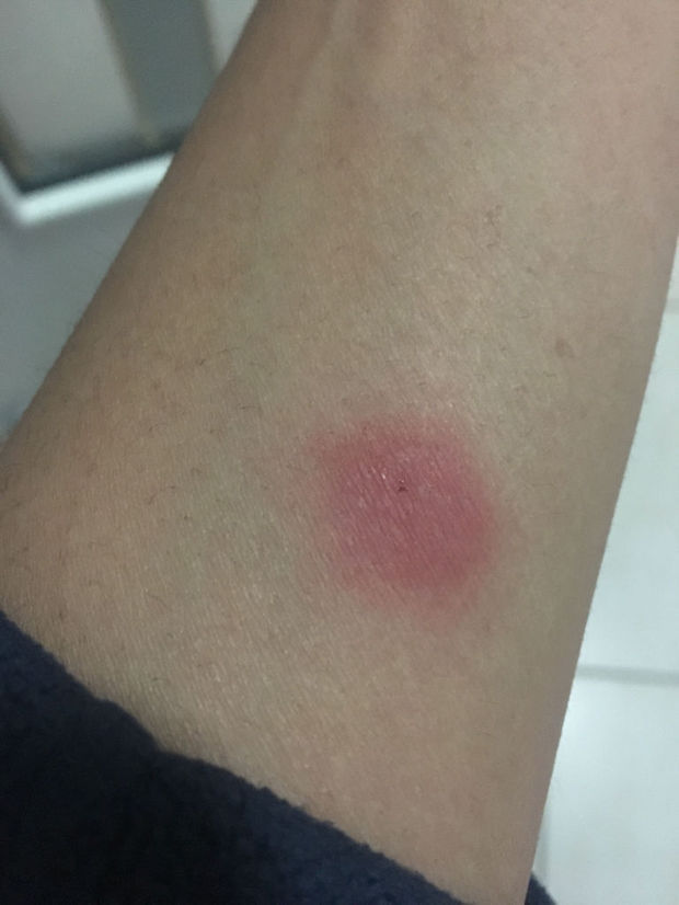 ppd试验后红肿