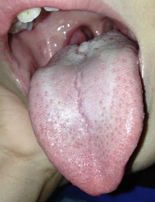舌头底下起泡,靠近舌头根部,是什么原因