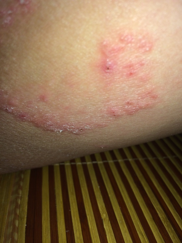 我腰上长的一圈疹子 还特别痒 很想知道是什么