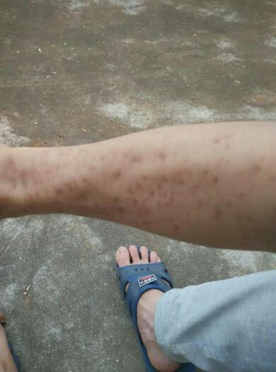 洗澡的时候就发现2个手臂上都是红点不痛不痒的,现在过了几天就成这个
