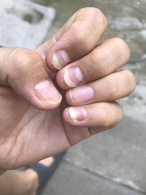 我这个指甲好几年了,之前以为是灰指甲去化验过,化验结果没有真菌,一